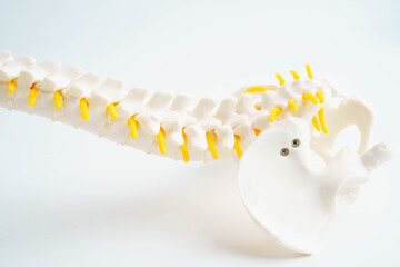 Spinal nerve and bone, Lumbar spine displaced herniated disc fragment, Model for treatment medical...