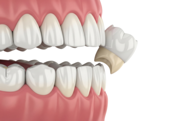 Dental Crown Procedure: Molar Tooth Restoration with a New Crown Being Placed - 3D Render Illustrating Modern Dentistry and Oral Health Care