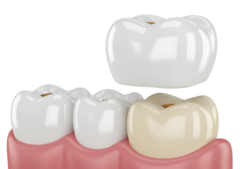 Dental Crown Placement on Tooth - 3D Illustration of Oral Restoration