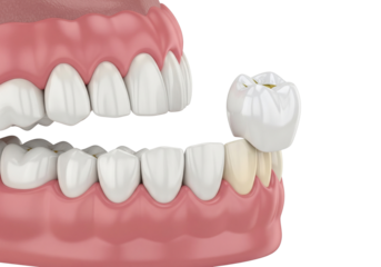 3D Render: Dental Crown Placement. Detailed illustration of tooth restoration, prosthetic dentistry, and oral health care. Dental procedure concept.
