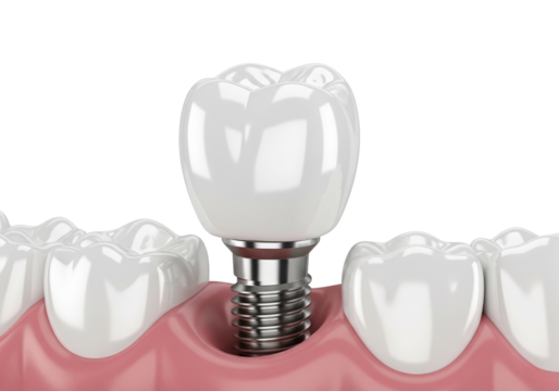 Dental Implant System: 3D Illustration of a Modern Tooth Replacement Solution