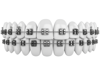 3D Render of Traditional Metal Braces on Perfectly Aligned White Teeth - Orthodontic Treatment Concept