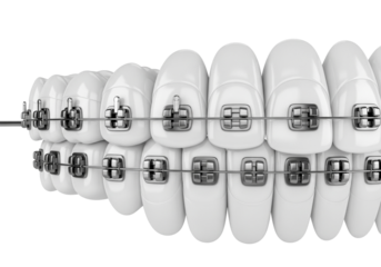 Detailed 3D Model of Teeth with Metal Braces. Orthodontic Treatment Concept for Dental Alignment and Correction on White Background.
