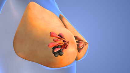 Breast Fibroadenoma Treated with Thermal Ablation Procedure