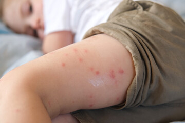Child scratch body has sensitive itchy skin. Bodily rash. Kid allergy closeup. Little baby scratches eruption. Irritation, hive. Pruritus. Mosquito insect bite. Red from sunburn, Seborrheic Dermatitis