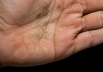 Hand with skin lesions
