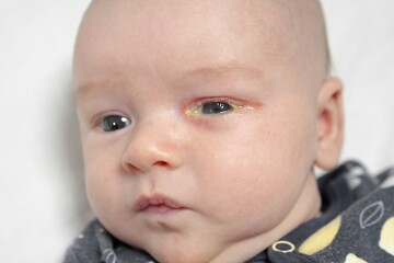 Baby eyes with eye mucus in selective focus. Disease tear ducts tons of newborns close up. Nasolacrimal duct obstruction in baby it is a blockage of the lacrimal drainage system. 