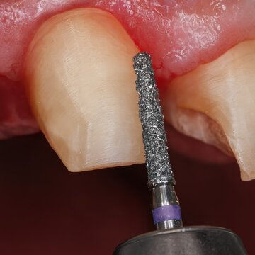 Close-up of dental crown preparation with diamond bur drill on front tooth, enamel reduction process for prosthetic restoration
