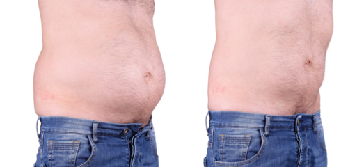 before and after of man with belly fat
