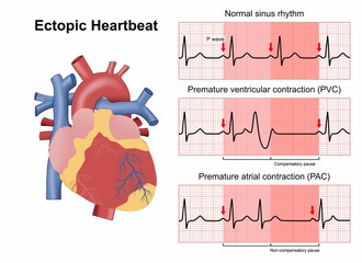 Ectopic heartbeat flashcard medical illustration