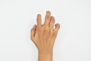 Hand with Clawlike Deformity Caused by Volkmann Ischemic Contracture