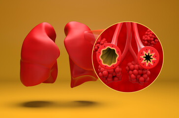 Normal and asthmatic bronchial tube in lung - isometric view 3d illustration
