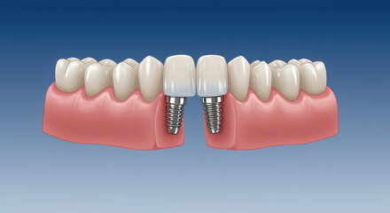 Fototapeta premium Dental Implants and Healthy Gums A Modern Solution for Missing Teeth and Dental Health Illustrated with Precision