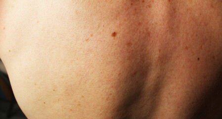 Back of a man with freckles and moles on the skin