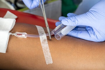Close-up of a healthcare worker cutting blood tube during donation procedure. Medical gloves,...