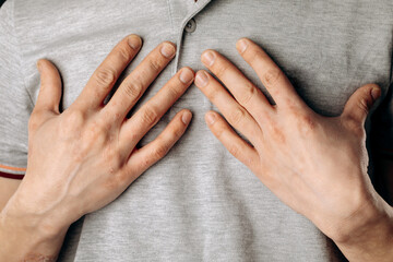 Close-up of men's hands with dry skin damage. The concept of dermatology is human hands with skin...