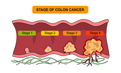 Stage of colon cancer illustration. Concept of colorectal cancer progression. Spread of tumor to lymph nodes. Medical vector illustration for clinics, education, and science.