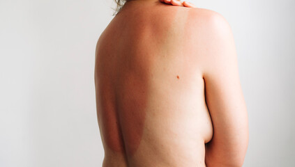 View of the sun-burnt skin of a woman's back.