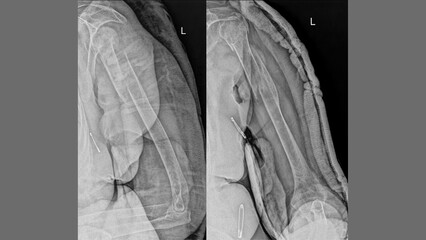X-ray of showing upper limb fracture – lateral and AP views