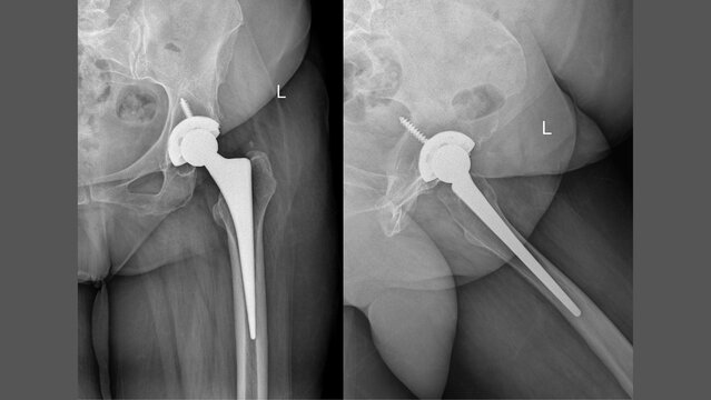 Post-operative X-ray of left hip showing total hip replacement with femoral stem, prosthetic head, and acetabular cup &ndash; AP and oblique views