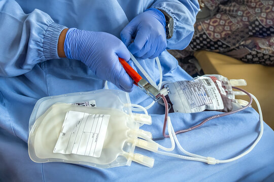 Healthcare worker in protective gloves handling a blood donation bag, sealing tube with medical clamp, representing hospital procedure, transfusion, and life-saving healthcare service.