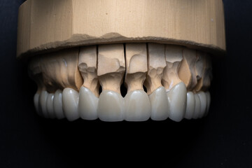 Metal-ceramic crowns isolated on black background. Crowns on a upper jaw model in aesthetic dentistry.