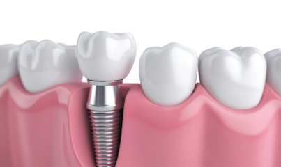 Dental implant embedded in gum with ceramic crown, isolated on transparent cutout background
