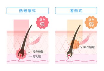 レーザー脱毛、熱破壊式・蓄熱式の比較イラスト
