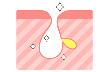 きれいな毛穴　角栓除去後の毛穴の断面図