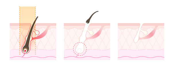 医療脱毛・レーザー脱毛のしくみ