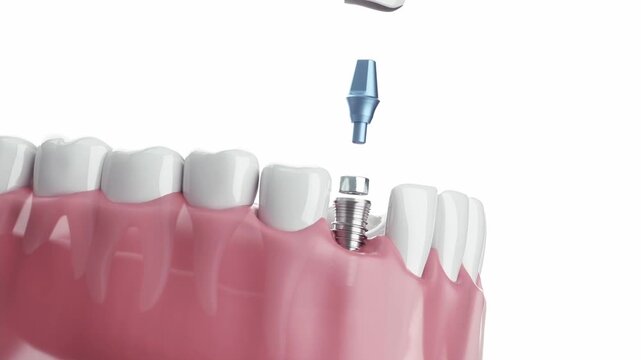 Dental implants and ceramic crowns. Front teeth, dental implant structure, screw crown, bright and fresh background, dental surgery 3D animation.