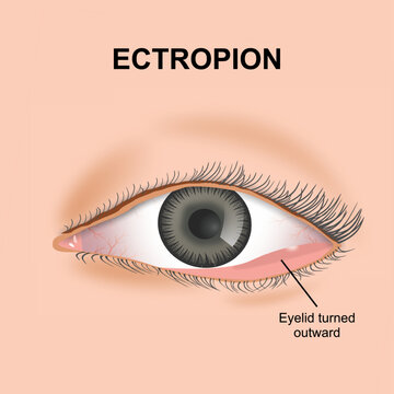 Ectropion eyelid flashcard eye illustration