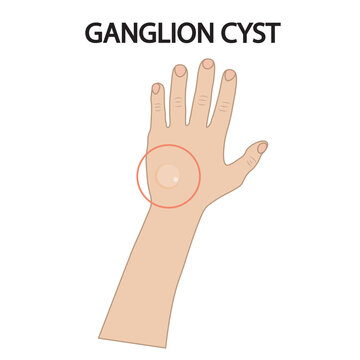 Vector illustration of ganglion cyst showing a fluid-filled lump with pain, stiffness, tingling, and weakness, alongside related conditions like lipoma and synovitis hand icon