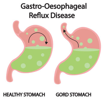 Vector illustration of gastro-oesophageal reflux disease showing heartburn, regurgitation, chest discomfort, plus related conditions like gastritis, peptic ulcer, and hiatal hernia stomach