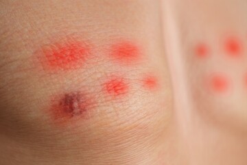 Fototapeta premium Close up view of red itchy skin rash with small blisters and inflammation