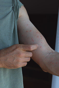 Damaged skin on male's hand. Allergy signs. Bedbug bites, moosquito bites or skin disease on human 