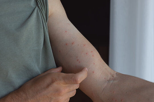 Damaged skin on male's hand. Allergy signs. Bedbug bites, moosquito bites or skin disease on human 