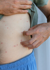 Damaged skin on male's belly. Allergy signs. Bedbug bites, moosquito bites or skin disease on...
