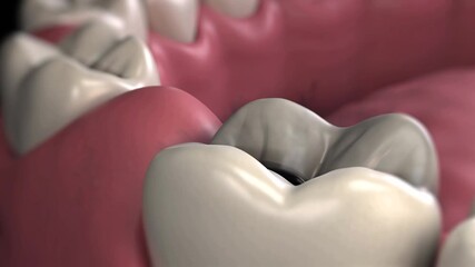 close-up of teeth affected by caries