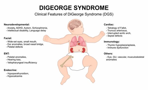 DiGeorge syndrome clinical feature flashcard illustration