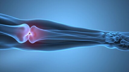 3D medical animation of a painful, arthritic elbow joint glowing magenta.
