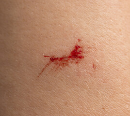 A red mark on a person's arm
