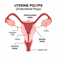 Uterine Polyps (endometrial polyp) medical flashcard