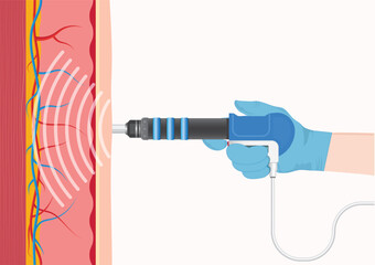 Extracorporeal Shock Wave Therapy (ESWT) is a non-invasive medical treatment using