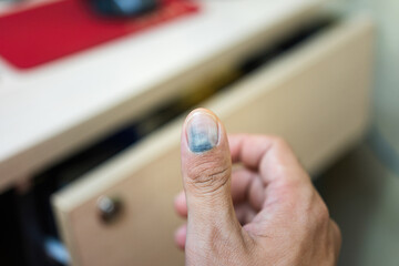 Human thumb finger is hurt by drawer pinched, cause blood blister inthe nail. Unsafe or hazard at workplace, close-up with selective focus.