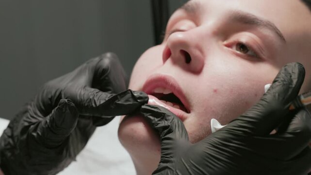 A detailed closeup view of a lip enhancement treatment procedure being applied with utmost precision and care