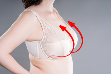 Breast augmentation, woman with large saggy breasts after aesthetic lifting procedure, reduction mammoplasty, plastic surgery, healthcare and medicine concept