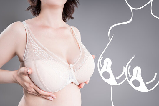 Breast augmentation, woman with saggy breasts after aesthetic lifting procedure, reduction mammoplasty, nipples and areolas plastic surgery concept