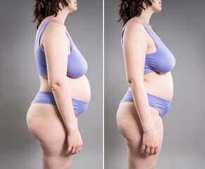 Tummy tuck, fat body before and after weight loss and liposuction on gray background, plastic...