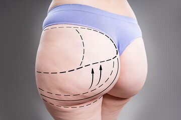 Buttocks liposuction, fat and cellulite removal, overweight female body with painted surgical lines and arrows, plastic surgery concept